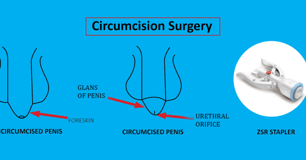 Laser Circumcision Surgery