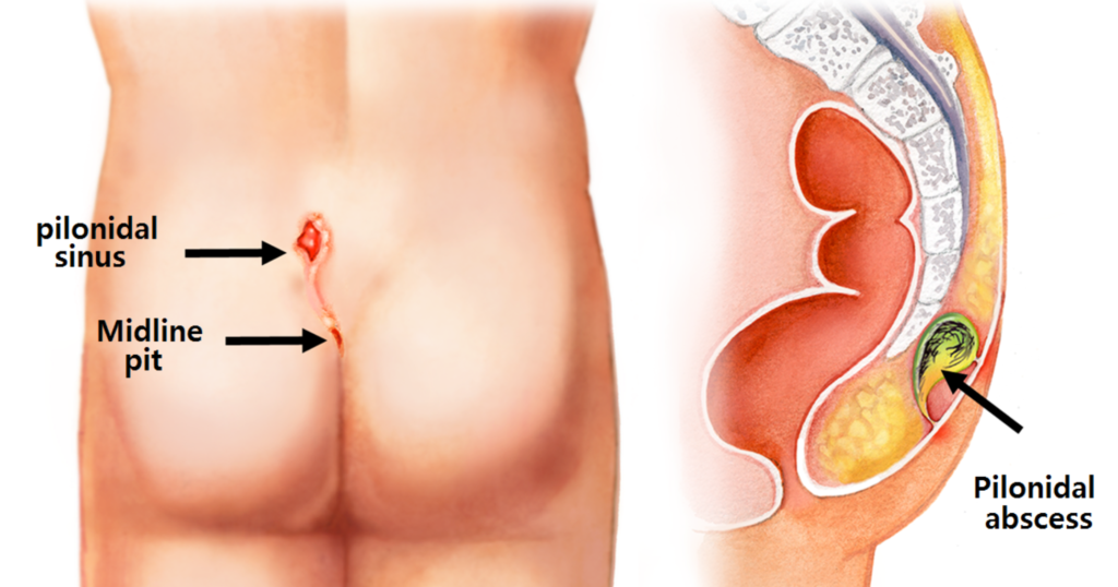 Laser Pilonidal Sinus Treatment