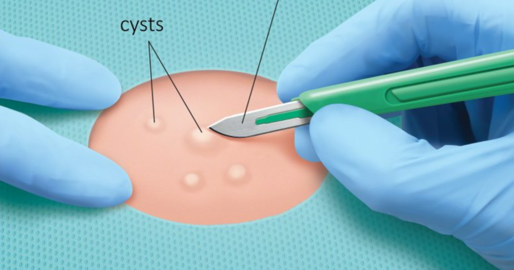 Sebaceous Cyst Removal in Hyderabad – Amista Hospitals